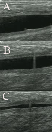 im&aacute;genes ecogr&aacute;ficas del tratamiento de una lesi&oacute;n muscular